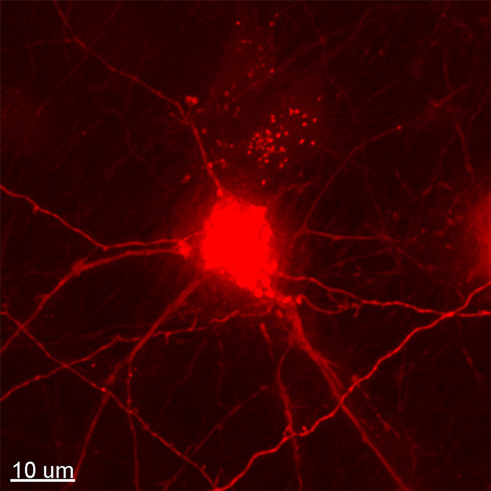Human induced pluripotent stem cell-derived dopaminergic neurons expressing mCherry-galectin 3 (red).