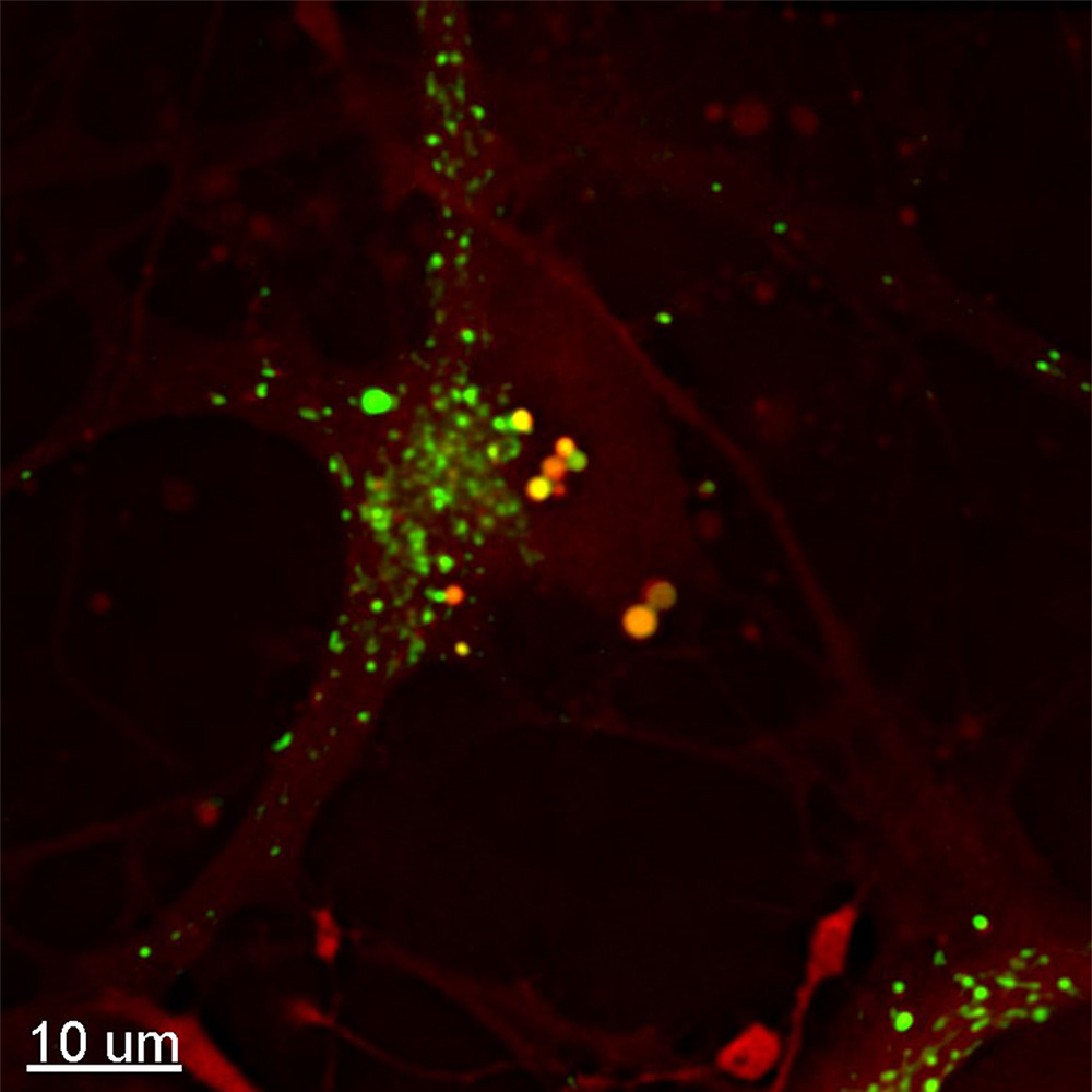 Human induced pluripotent stem cell-derived dopaminergic neuron expressing mCherry-galectin 3 exposed to exogenous aggregates of alpha-synuclein (green). 