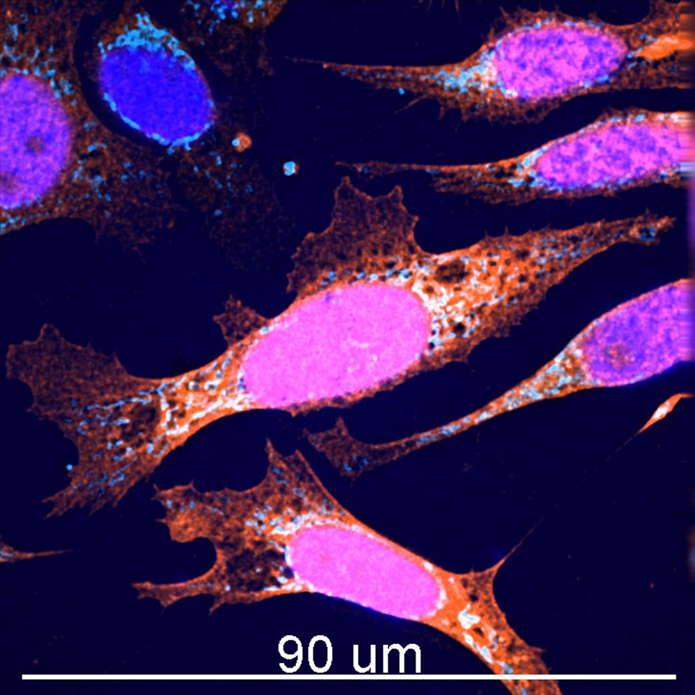 Human neuroblastoma cell line expressing mCherry-galectin 3 (orange) and stained for actin (white) and DNA (blue).
