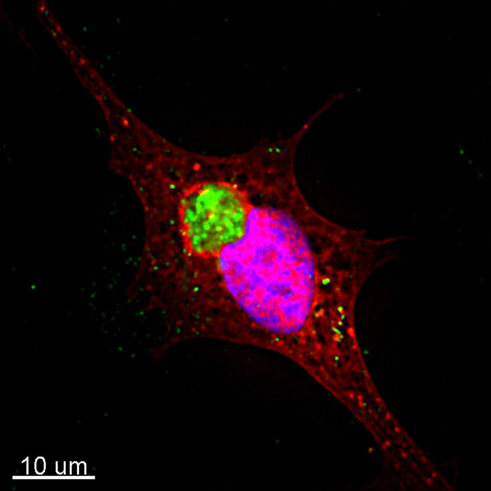 Human neuroblastoma cell line expressing mCherry-galectin 3 (red) exposed to exogenous aggregates of alpha-synuclein (green).